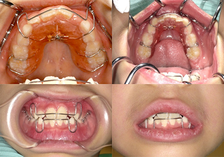 子どもの矯正 | 兵庫県尼崎市のかわばた矯正歯科