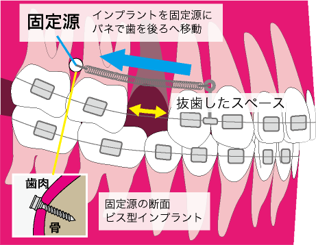 矯正用アンカースクリュー | 兵庫県尼崎市のかわばた矯正歯科